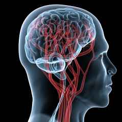 Stroke